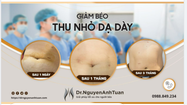 Vết sẹo sau phẫu thuật nội soi Thu nhỏ Dạ dày như thế nào?