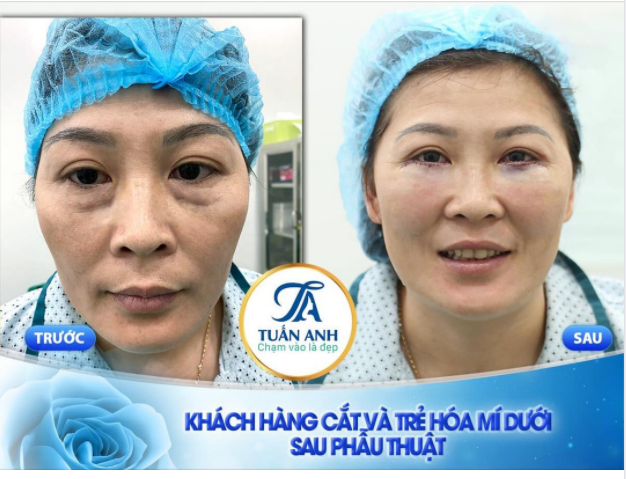 CHẠM VÀO LÀ ĐẸP - CẮT VÀ TRẺ HÓA MÍ DƯỚI ĐẸP XUẤT SẮC