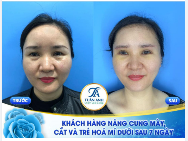 Feedback sau 1 tuần phẫu thuật của khách hàng NÂNG CUNG MÀY + CẮT VÀ TRẺ HÓA MÍ DƯỚI
