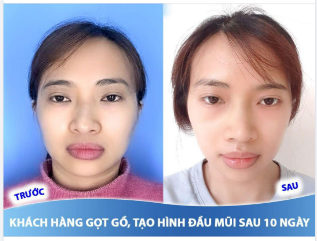 Feedback sau 10 ngày GỌT GỒ + TẠO HÌNH ĐẦU MŨI