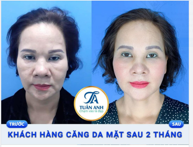 FEEDCACK SAU 2 THÁNG PHẪU THUẬT CĂNG DA MÁ, CỔ, HÚT MỠ NỌNG CẰM