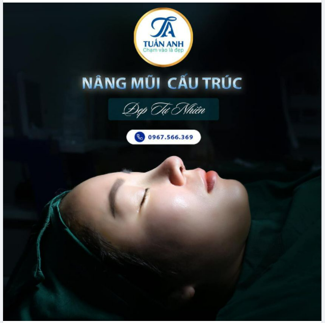 KẾT QUẢ DÁNG MŨI PURI - FORM SAU 60 PHÚT PHẪU THUẬT ĐẸP XUẤT SẮC CỦA EKIP BÁC SĨ TUẤN ANH