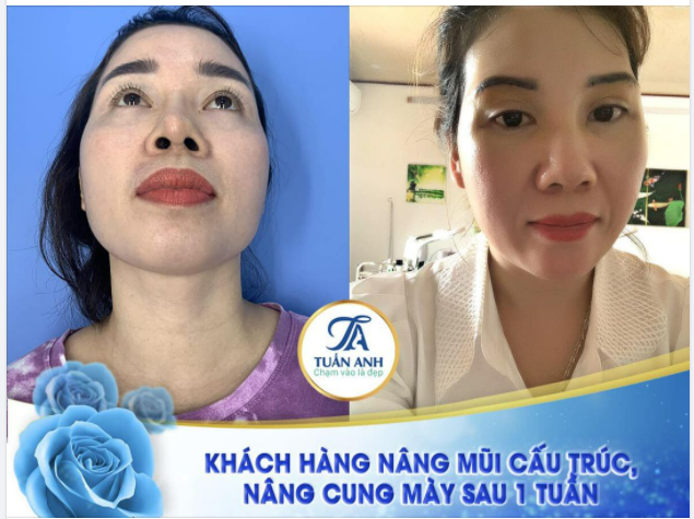 NÂNG MŨI CẤU TRÚC + NÂNG CUNG CHÂN MÀY