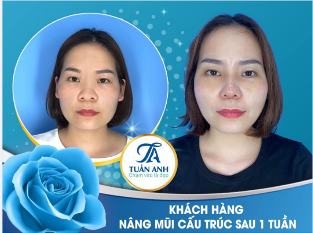 NÂNG MŨI CẤU TRÚC TRỢ GIÁ 25%