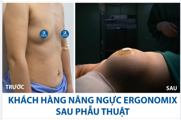Nâng vòng 1 tại thẩm mỹ Tuấn Anh giá cao vì sao