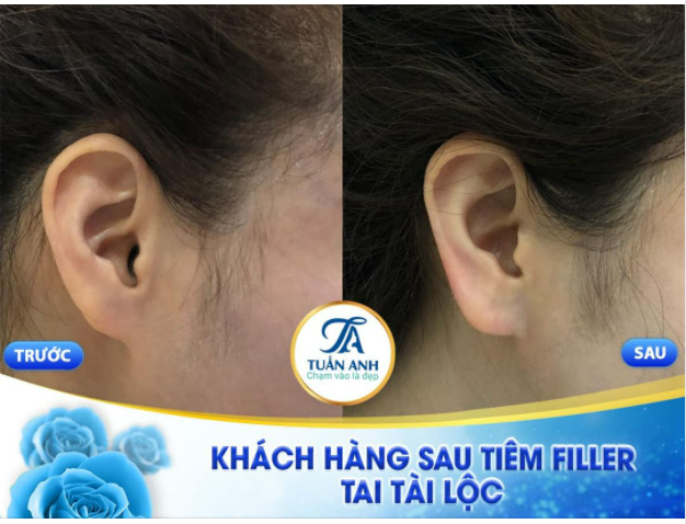 TIÊM TAI TÀI LỘC - FILLER CHUẨN BỘ Y TẾ