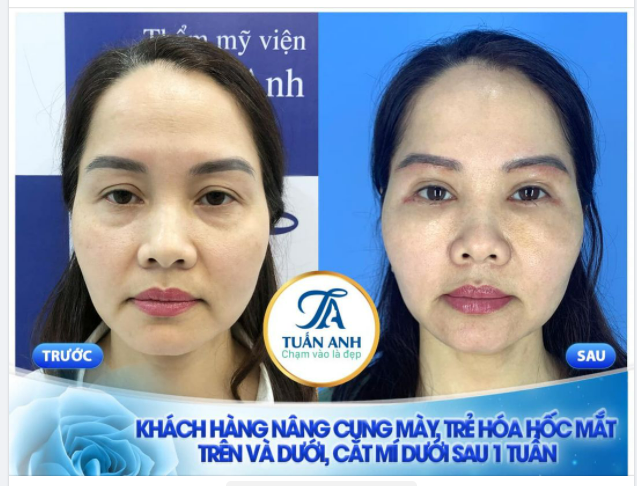 TRẺ RA 10 TUỔI SAU 1 TUẦN TRẺ HÓA TOÀN DIỆN ĐÔI MẮT VỚI COMBO DỊCH VỤ HOT