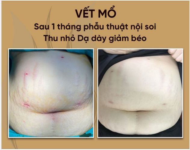 Vết mổ của bệnh nhân sau 1 tháng thực hiện Thu nhỏ Dạ dày giảm béo
