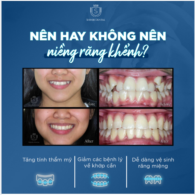CÂU HỎI MUÔN THUỞ NÊN HAY KHÔNG NÊN NIỀNG RĂNG KHỂNH