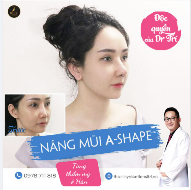 CHÚC MỪNG CHỊ GÁI XINH ĐẸP NHƯ BÚP BÊ VỚI DÁNG MŨI A-SHAPE ĐỘC QUYỀN CỦA DR TRÍ