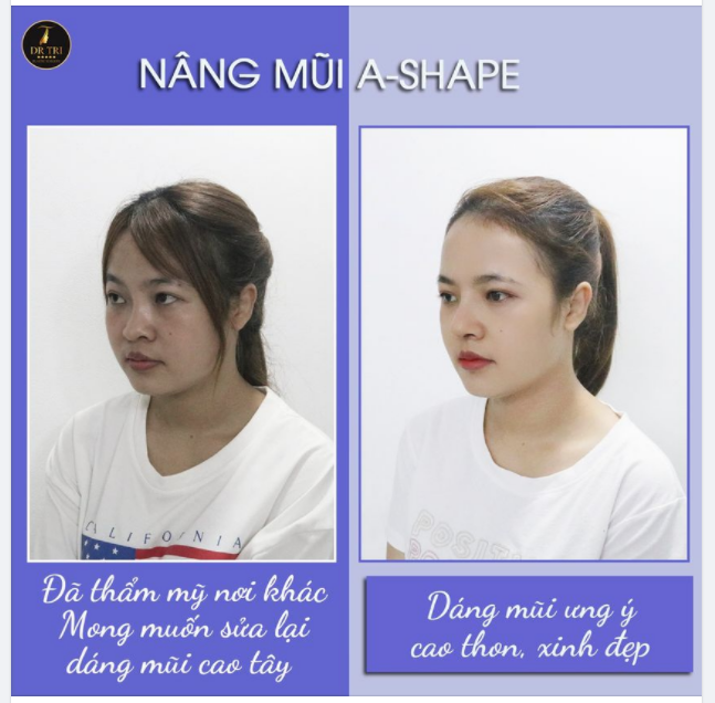 Chúc mừng cô gái thành công thay đổi diện mạo với Dáng mũi Ashape độc quyền của Dr.Trí!