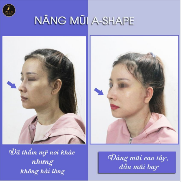 ĐÃ SỬA MŨI 2-3 NƠI VẪN CHƯA HÀI LÒNG!