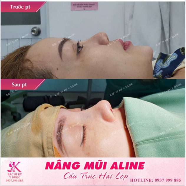 DÁNG MŨI ALINE THANH THOÁT CHO BẠN NỮ TUỔI ĐÔI MƯƠI