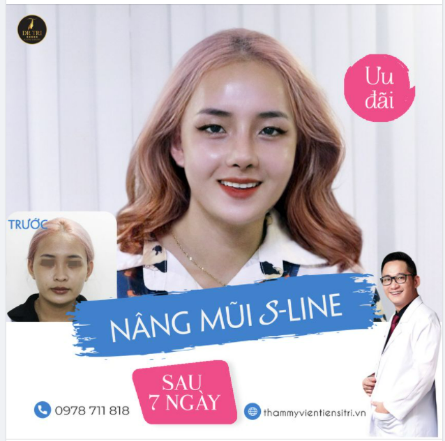 Em gái được dì đặt lịch gặp Dr Trí thực hiện cải thiện dáng mũi, mong muốn xinh đẹp hơn để có nhiều cơ hội trong cuộc sống.