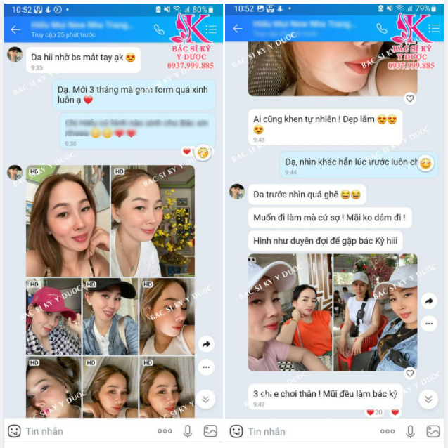 Feedback đỉnh cao của bạn khách sau 3 tháng Nâng mũi ALINE.