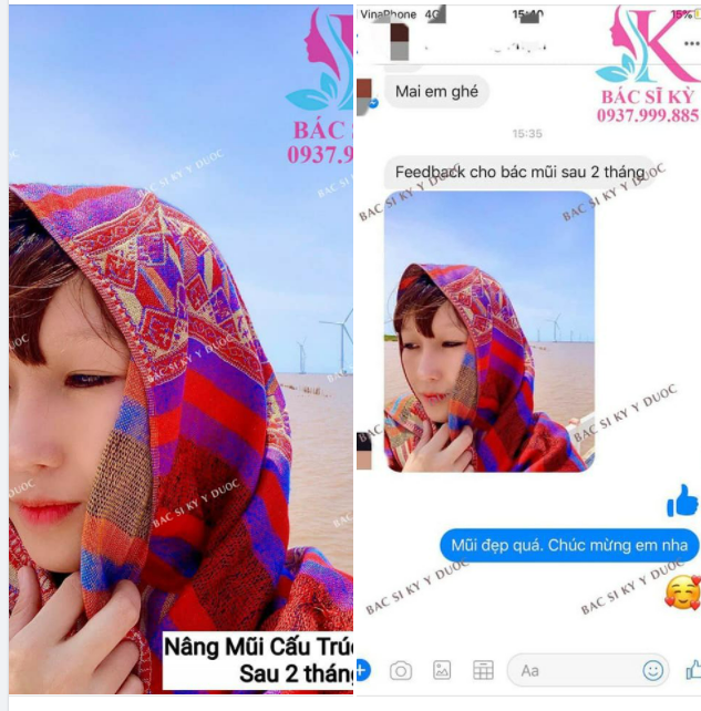 FEEDBACK Khách hàng nâng mũi ALINE cấu trúc SAU 2 THÁNG