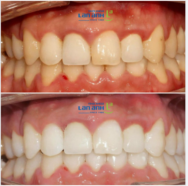 Nếu răng sứ “lỡ” bị trắng hơn so với răng thật, bạn sẽ làm gì