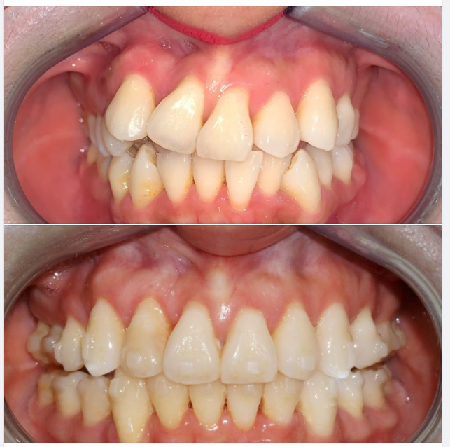 Nhẹ nhàng một ca niềng Invisalign ở mức độ chen chúc nặng, lệch đường giữa nặng của một chị tuổi trung trung !