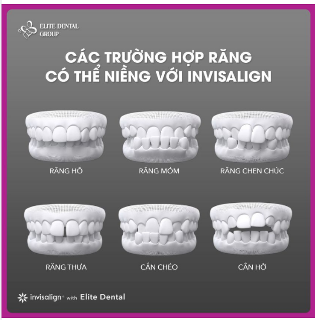 Bạn nên niềng răng với Invisalign khi nào
