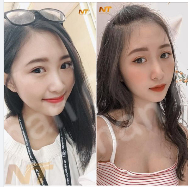 CẮT MÍ ĐẸP TỰ NHIÊN CAM KẾT KHÔNG SƯNG KHÔNG ĐAU,MÍ ĐỀU ĐẸP TỰ NHIÊN,KHÔNG CẦN NGHỈ DƯỠNG