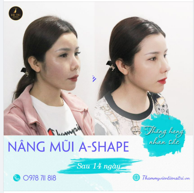 Dáng mũi A-Shape sau 14 ngày của chị khách có cơ địa dị ứng, đã nâng mũi nhiều lần nơi khác.