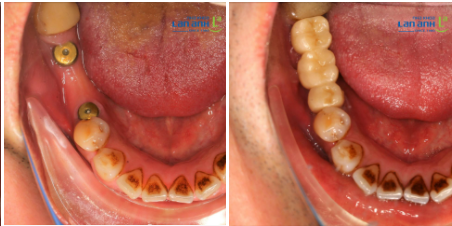 Đặt Implant của bác sĩ Vũ, chi nhánh 61 Nguyễn Cơ Thạch, Sala, quận 2!