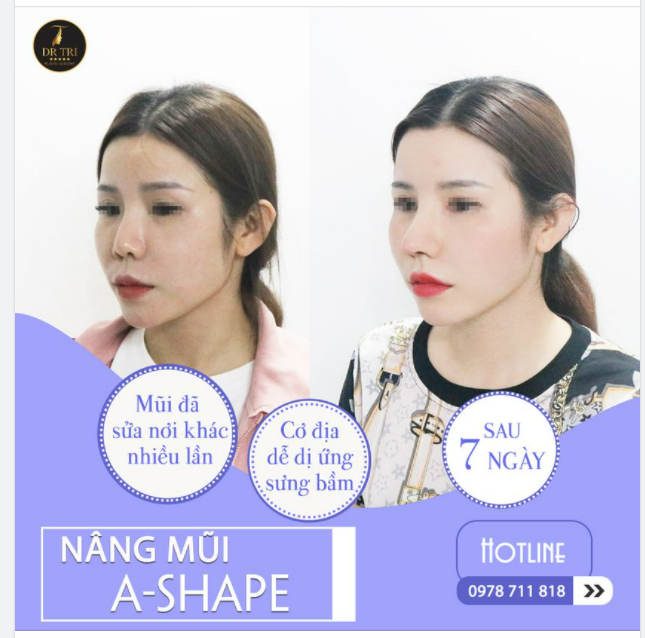 Đến Dr Trí mũi khó mấy cũng thành công