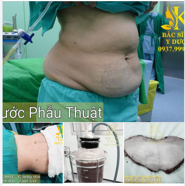 Hút mỡ - căng da bụng toàn phần ( Siết eo - Tạo cơ )