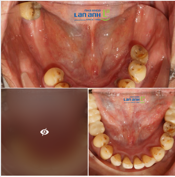 Khi bạn bị mất răng nhiều, tạo khoảng trống lớn, thì giải pháp phù hợp là cấy ghép Implant.