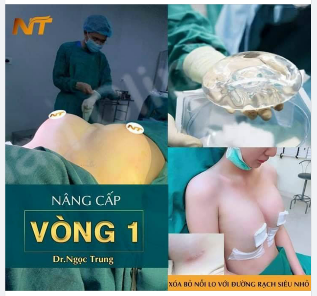 Làm ngực nhanh diện hè thôi chị em ơi....