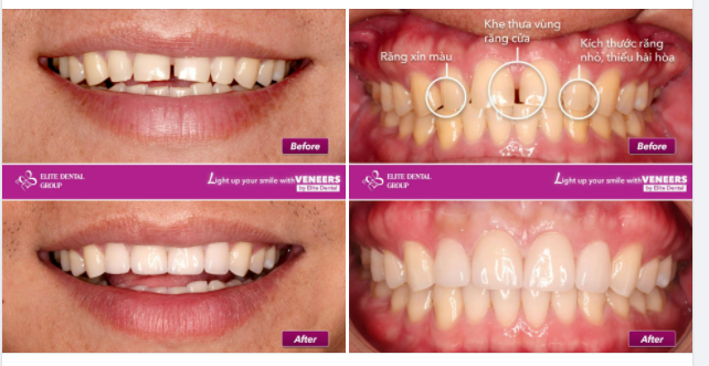 MẶT DÁN SỨ VENEER - THAY ĐỔI NHỎ CHO NỤ CƯỜI RẠNG RỠ