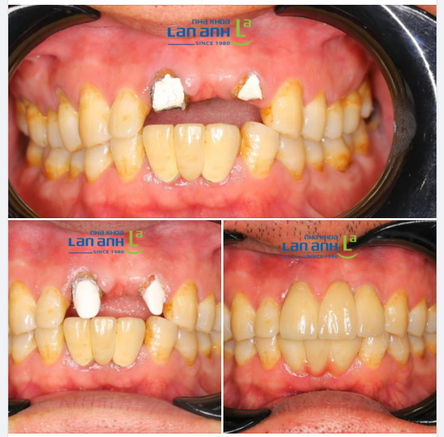 Một ca phục hình răng sứ của bác sĩ Đức, chi nhánh Sala, quận 2.