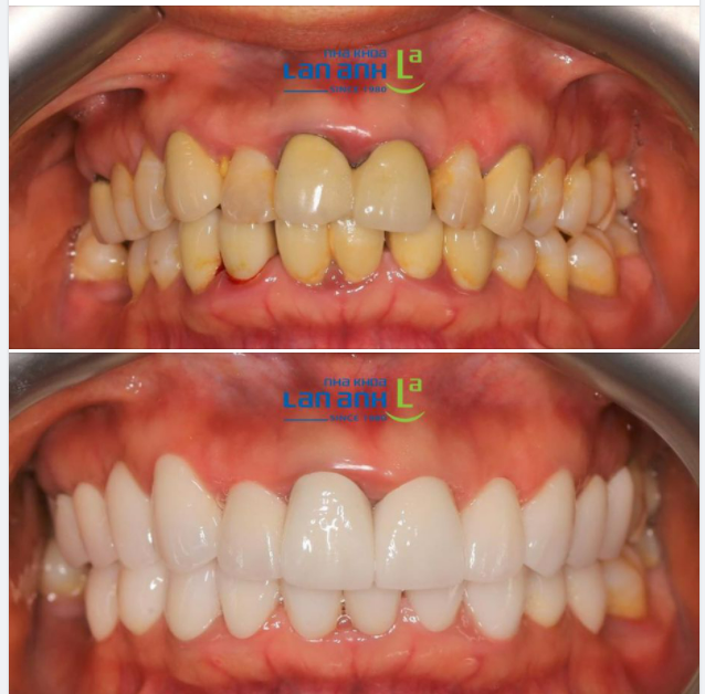  Một trường hợp phục hình sứ thẩm mỹ của bác sĩ Hiền, chi nhánh 11 Nguyễn Cơ Thạch, khu đô thị Sala, quận 2!
