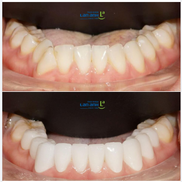 Một trường hợp phục hình sứ thẩm mỹ theo phong cách tự nhiên của bác sĩ Dũng, chi nhánh 149 Tôn Dật Tiên, quận 7!