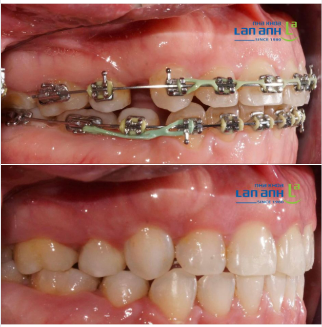 Nhiều bạn hỏi ad là đang niềng ở nơi khác mà chuyển nơi ở, chuyển nơi làm việc có thể chuyển qua nha khoa Lan Anh để điều trị tiếp không