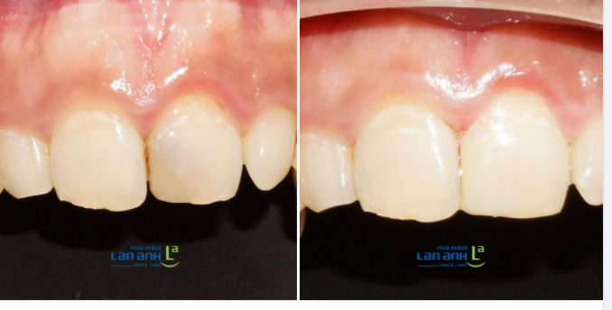 Nhiều bạn hỏi ad là răng cửa bị mẻ có thể trám thẩm mỹ, chứ đừng bọc sứ được không?