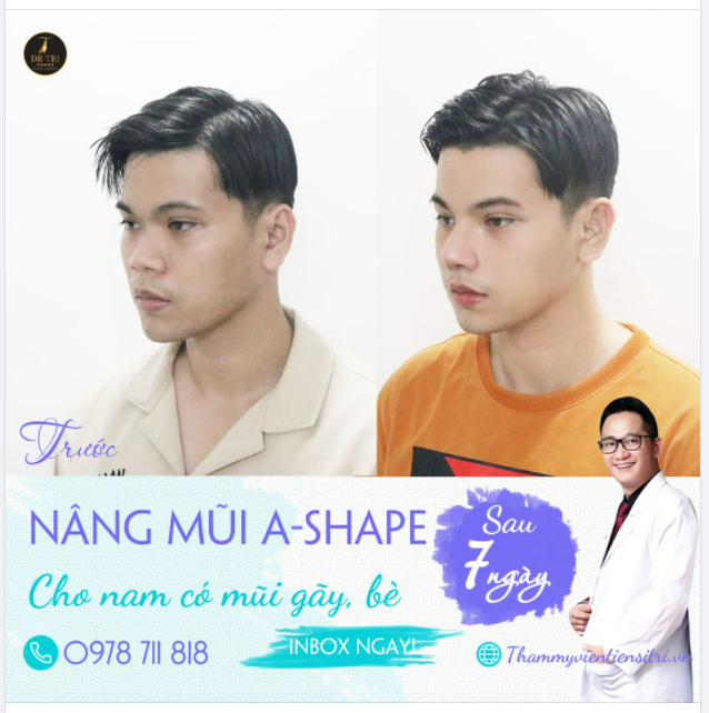 Thành Công Thay Đổi Dáng Mũi, Chàng Trai Có Gương Mặt Đẹp Trai Chuẩn Nam Thần Thanh Xuân!