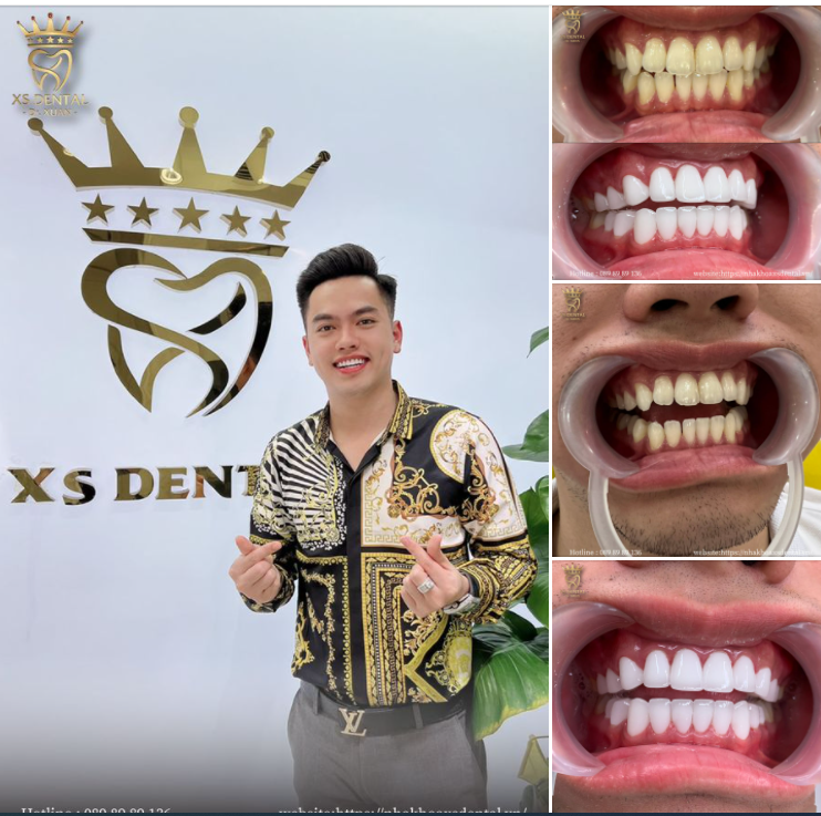 THÊM PHẦN CUỐN HÚT SAU KHI BỌC RĂNG SỨ