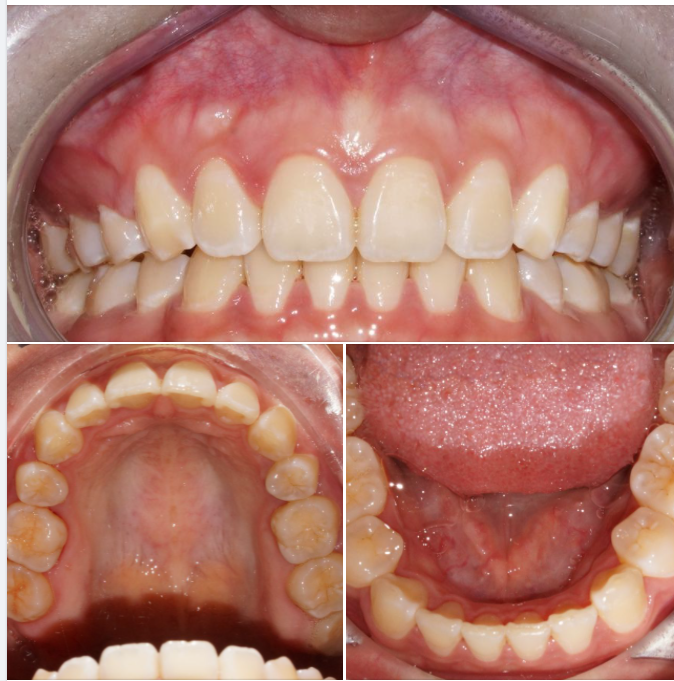 Với những bác sĩ chỉnh nha giỏi, chúng tôi thậm chí không cần bàn luận nhiều về hình ảnh ban đầu trước khi chỉnh nha, mà chỉ nhìn vào hình ảnh khi kết thúc!