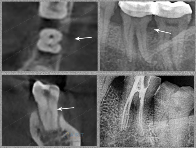Xin chia sẻ 1 ca bệnh nội nha răng 37 khó.