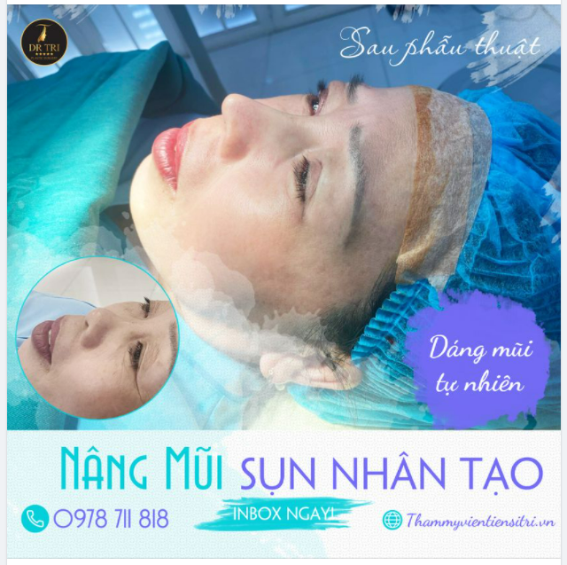 Xong ca Tạo hình mũi sụn nhân tạo cho chị khách thích dáng mũi tự nhiên
