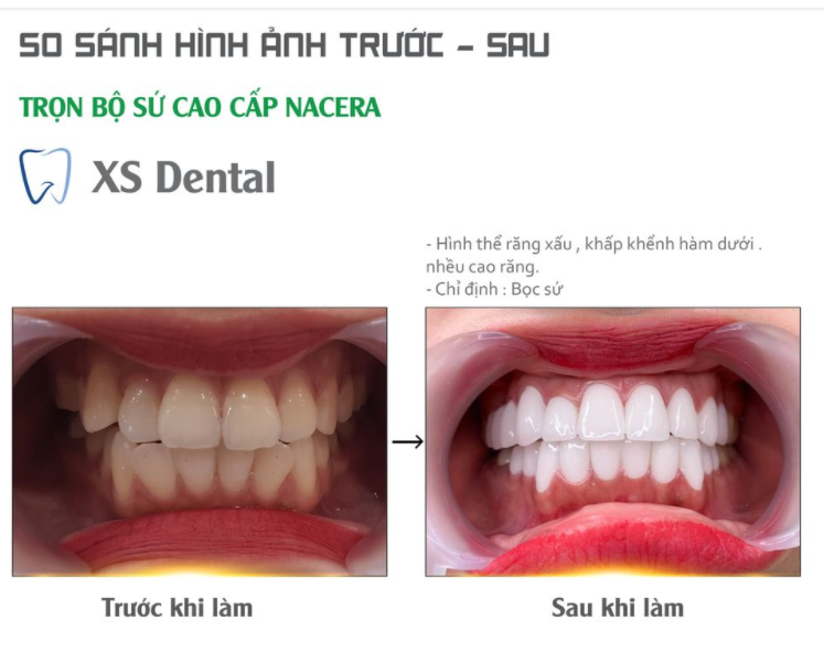 Xs kịp hoàn thành bộ 20r sứ cao cấp cho bạn gái xinh đẹp tới từ Hà Nội .