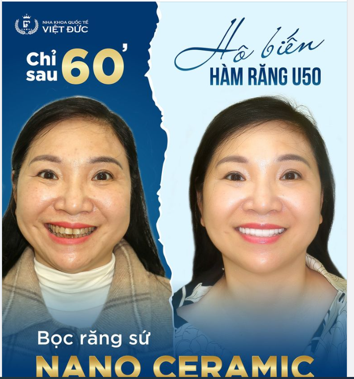 BỌC SỨ LÀ AUTO TRẺ RA 10 TUỔI