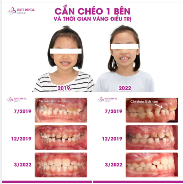CẮN CHÉO 1 BÊN VÀ THỜI GIAN VÀNG ĐIỀU TRỊ