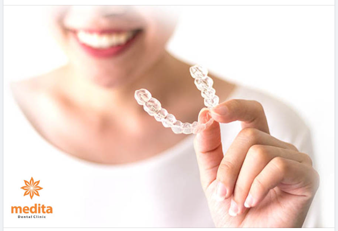 ĐIỀU ĐẶC BIỆT CHỈ CÓ Ở NIỀNG RĂNG TRONG SUỐT