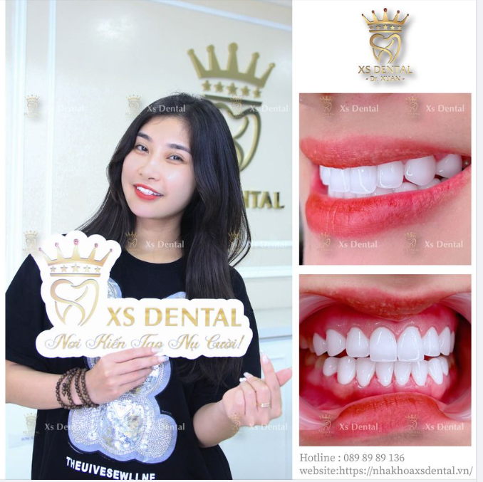 FORM RĂNG TỰ NHIÊN - ĐÍCH ĐẾN CỦA GU THẨM MỸ TINH TẾ