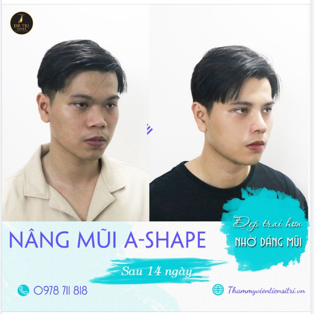 GIẬT MÌNH VỚI VẺ ĐẸP TRAI CHUẨN NAM THẦN NHỜ DÁNG MŨI ASHAPE CỦA Dr Trí