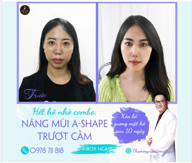 HẾT HÔ NHỜ COMBO TRƯỢT CẰM VÀ NÂNG MŨI ASHAPE