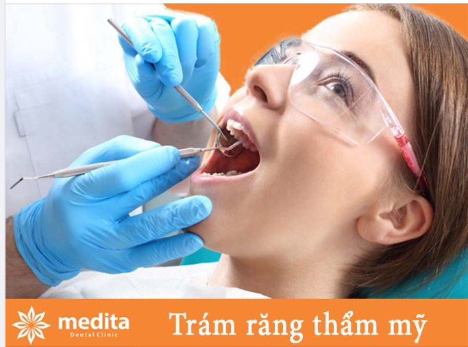 NHỮNG VẬT LIỆU TRÁM RĂNG PHỔ BIẾN