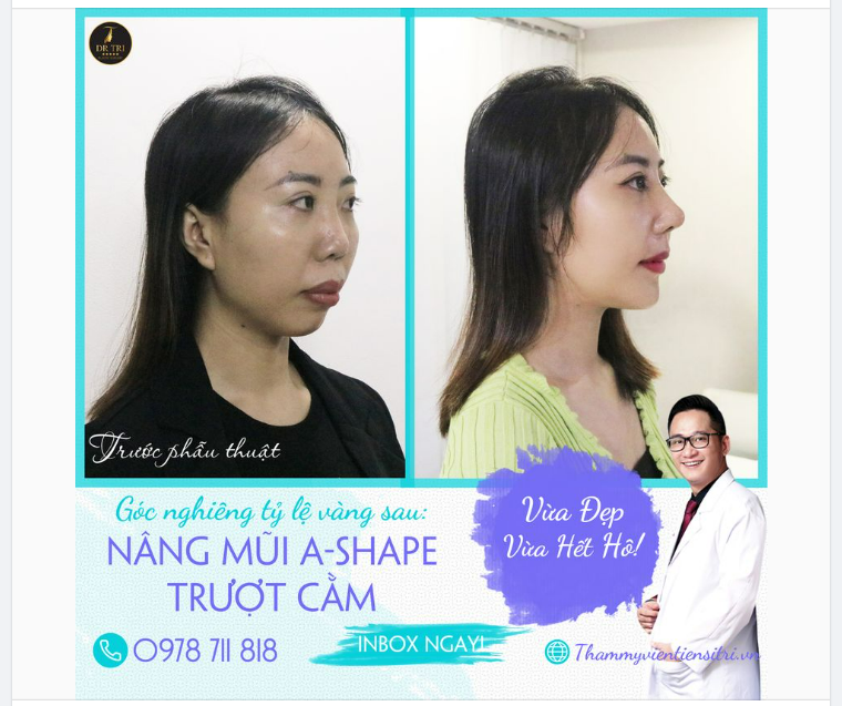 Sau TRƯỢT CẰM và NÂNG MŨI A-SHAPE đã khắc phục MẶT H